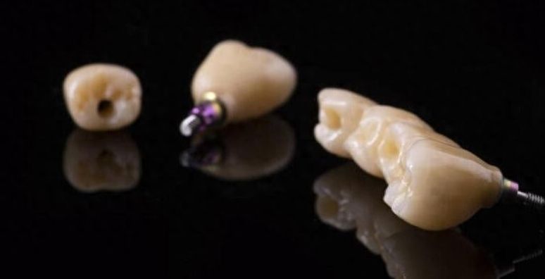 美奧口腔種植牙、牙齒矯正收費貴不貴？價格表告訴您
