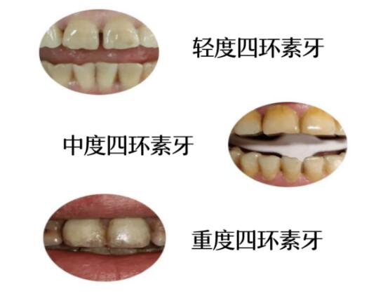 泰州口碑好的牙科醫(yī)院推薦，看牙價(jià)格費(fèi)用不貴