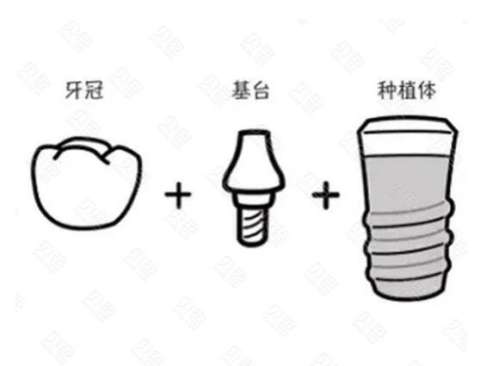 廣安種植牙醫(yī)院推薦  技術(shù)價格全方位解讀