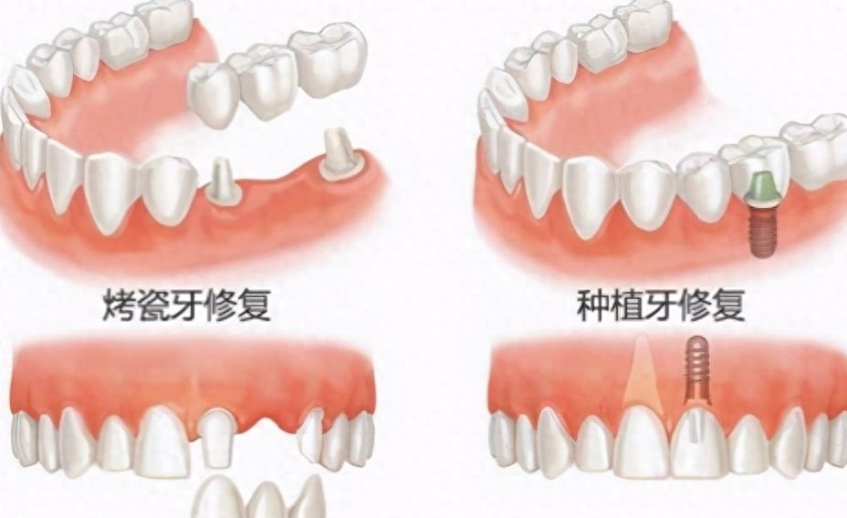 北京長庚醫(yī)院口腔種植技術(shù)如何？費用解析及口碑測評